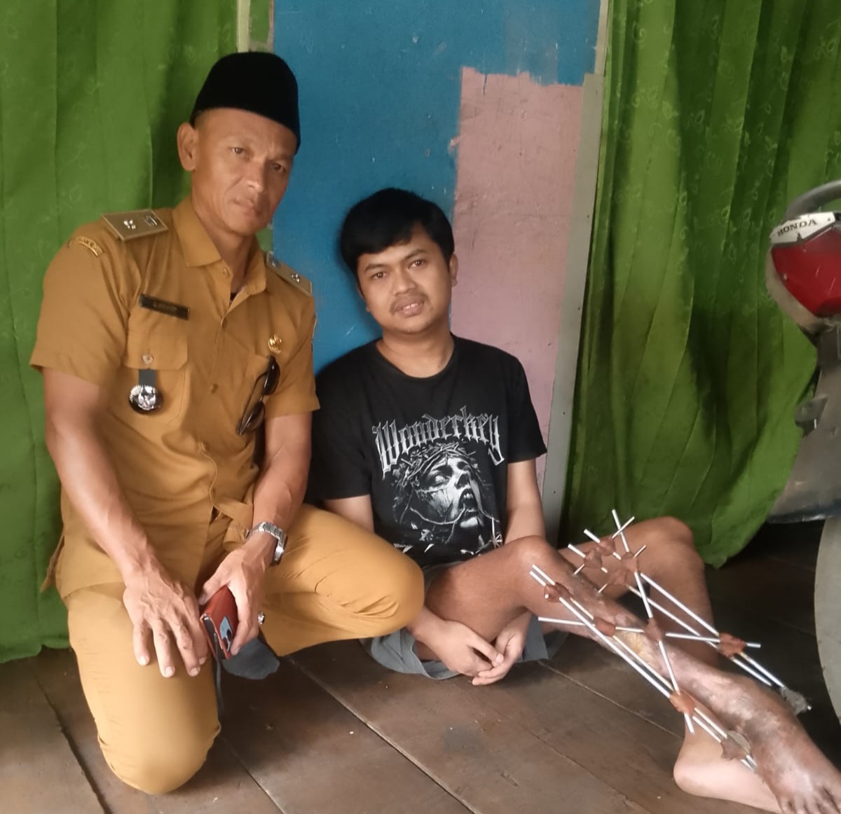 Warga Cikajang 9 Tahun Kecelakaan Patah Kaki, Pemdes Baru Tahu Saat Program Pajero Disdukcapil Garut